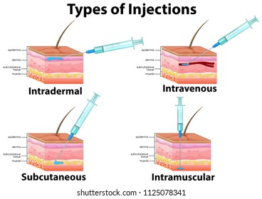 7,516 Intramuscular injection Images, Stock Photos & Vectors | Shutterstock