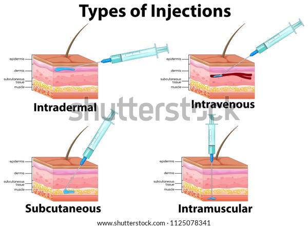 A Set of Type of\
Injections illustration