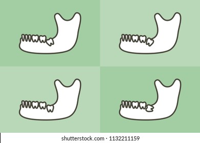 set of type of wisdom tooth in mandible or lower jaw - dental cartoon vector flat style cute character for design