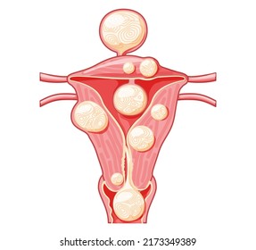 Set of Uterine fibroids Female leiomyomas reproductive system uterus in different styles and cross sections. Front view in a cut. Human anatomy medical illustration isolated internal organs flat icon