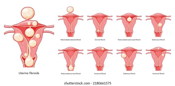 Set of Uterine fibroids Female leiomyomas reproductive system uterus. Front view in a cut. Human anatomy medical illustration isolated internal organs location scheme, cervix flat style icon