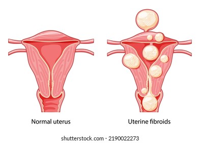 Set Of Uterine Fibroids Female Leiomyomas Reproductive System Uterus Normal And With Disease Pain. Human Anatomy Medical Illustration Isolated Internal Organs Cervix, Fallopian Tube Flat Style Icon