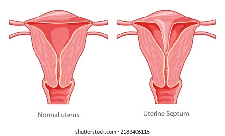 Set of Uterine septum septate uterus Female reproductive system diagram normal and with disease pain. Front view in a cut. Human anatomy internal organs flat icon Vector medical illustration