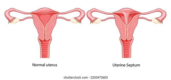 Set of Uterine septum septate uterus normal and with disease Female reproductive system diagram. Front view in a cut. Human anatomy scheme, cervix flat style icon Vector medical illustration isolated