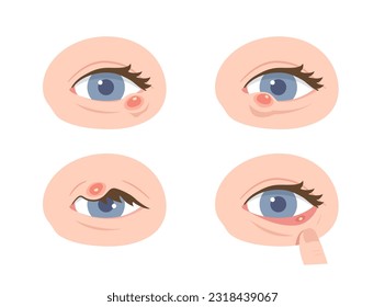 Set of various locations of stye eye. Concept of Hordeolum, infectious eye, Ophthalmology, medical illustration, health care. Flat vector illustration.