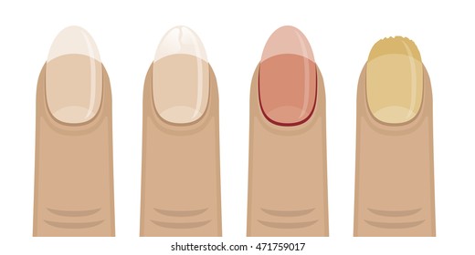 Set of vector icons with nail diseases. Women affected by fungus nails, brittle, sick.