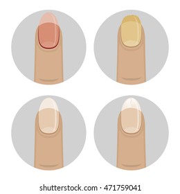 Set of vector icons with nail diseases. Women affected by fungus nails, brittle, sick.