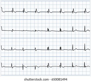 Set von Vektorgrafik des Herzrhythmus ekg, ecg auf Gitterhintergrund .vector