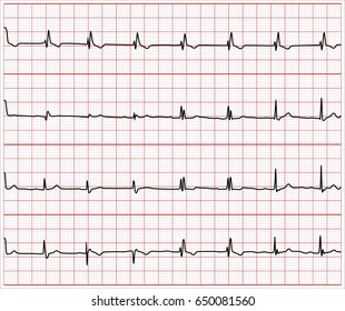 Set of Vector Illustration of heart rhythm ekg, ecg on grid background .vector