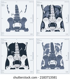 set vector x-ray of human abdomen with pelvic bone and spine. Medical diagnostics of the digestive system and kidneys