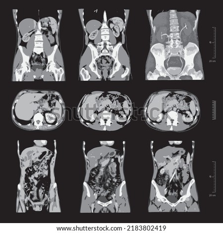 set vector x-ray of human abdomen with pelvic bone and spine. Medical diagnostics of the digestive system and kidneys