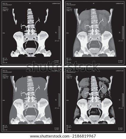 set vector x-ray of human abdomen with pelvic bone and spine. Medical diagnostics of the digestive system and kidneys