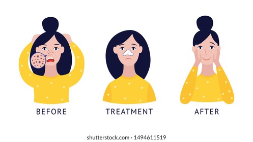 Set of woman with nose blackheads before and after treatment cartoon flat style, vector illustration isolated on white background. Steps of female problem skin acne treatment by cleansing strip