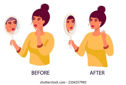 set of women sad Young woman hand mirror worrying about her acne on face in flat design. Pimple problem on female skin. and a satisfied girl with her skin condition. Before after svg