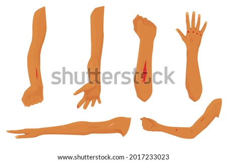 set of wounds and abrasions on hands isolated on white background. ripped knuckles, cuts, stitches on the wound, scars, scratches. injury. treatment of wounds. vector flat. hospital