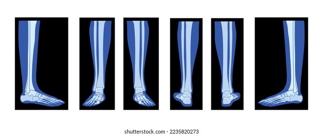 Set of X-Ray Foot Legs Skeleton Human body, Bones adult people roentgen front back side view. 3D realistic flat blue color concept Vector illustration of medical anatomy isolated on black background