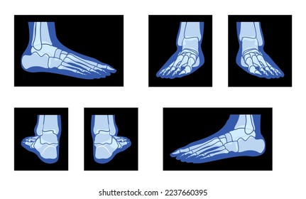 Set of X-Ray Foot Legs Skeleton Human body Bones adult people roentgen front back side view. 3D realistic flat blue color concept Vector illustration of medical anatomy isolated on black background