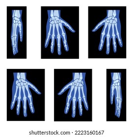 Set of X-Ray Hands Skeleton Human body, Bones adult people roentgen front back side view. 3D realistic flat blue color concept Vector illustration of medical anatomy isolated on black background