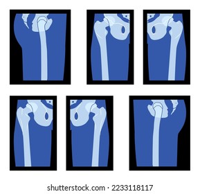 Set of X-Ray Hip and Leg, Head of the femur, Skeleton Human body Bones adult people roentgen front back side view. 3D realistic flat blue color concept Vector illustration of medical anatomy isolated