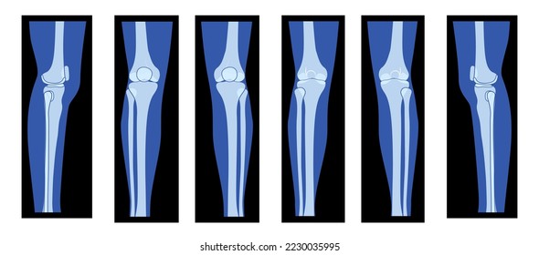 Set of X-Ray Knee femur leg Skeleton Human body - Patella, epicondyle, Tibia, Fibula Bones adult people roentgen front back side view. 3D realistic flat concept Vector illustration of medical anatomy