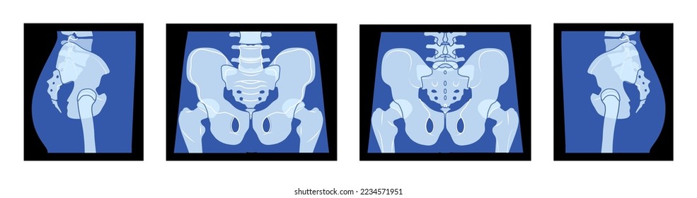 Conjunto de X-Ray pelvis Skeleton Hip Cuerpo humano Hueso adultos roentgen la vista lateral delantera. Concepto de color azul plano realista 3D Ilustración vectorial de la anatomía médica aislada en fondo negro