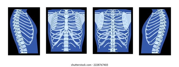 Set of X-Ray Rib cage Skeleton Human body - chest, vertebra, Bones adult people roentgen front back side view. 3D realistic flat blue color concept Vector illustration of medical anatomy isolated