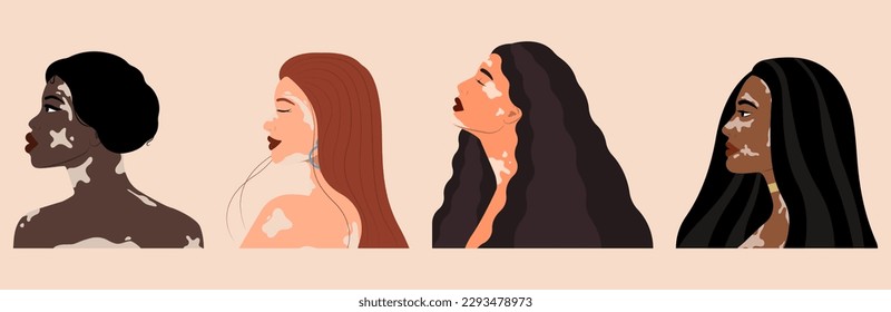 Set of young women with vitiligo on beige background