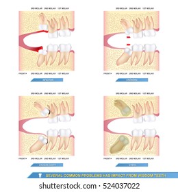 several common problems has impact from wisdom teeth