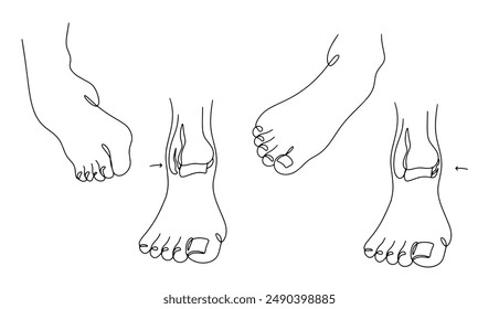 Several types of ankle fractures, hand drawn with a continuous black line. Injuries associated with turning the leg outward or inward. Vector illustration on white background.