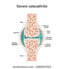 Severe osteoarthritis. Synovial joint with bone Spurs, Inflamed membrane, Decreased joint space, and Cartilage degradation. vector illustration