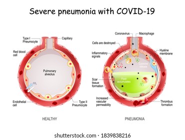 Severe pneumonia with COVID-19. healthy alveolus and Pulmonary alveolus full of fluid from acute pneumonia. Lungs Affected by coronavirus infection