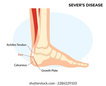 Sever's disease, calcaneal apophysitis. Ankle injury broken bone