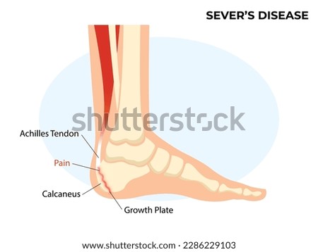 Sever's disease, calcaneal apophysitis. Ankle injury broken bone