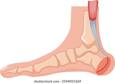 Sever's disease or calcaneal apophysitisis a common cause of heel pain in growing and physically active children 