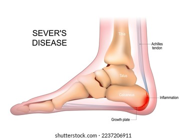 Enfermedad de Severs. apofisitis calcaneus. inflamación en la parte posterior de la placa de crecimiento del talón. Anatomía de pies. vista lateral de un pie humano con el nombre de los huesos. Arcos de los pies. anatomía esquelética