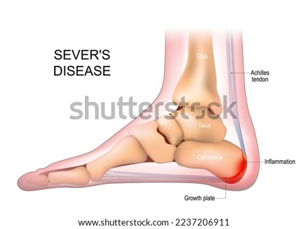 Severs disease. calcaneus apophysitis. inflammation at the back of the heel growth plate. Foot anatomy. side view of a Human foot with the name of bones. Arches of the feet. skeleton anatomy