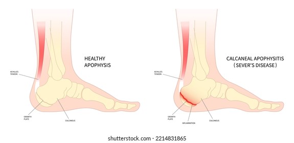 The sever's disease painful tendon tear and haglund's Flatfeet exercise Supination with Pronation obesity of trauma ankle injury broken bone