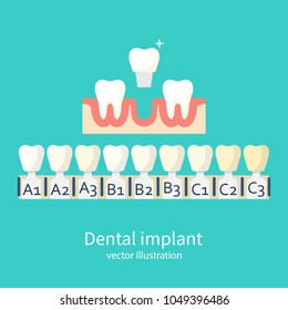 Shades of implants. Denture and implant production, teeth color samples. Veneers. Implant dental. Vector illustration flat design. Isolated on white background.