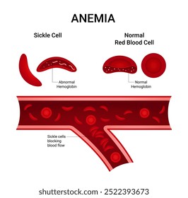 Shape of Sickle Cell with Abnormal Hemoglobin