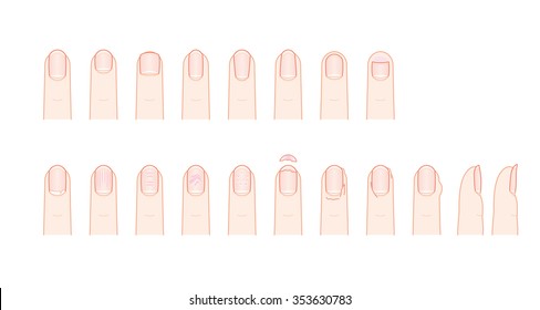 Shape and trouble of fingernail