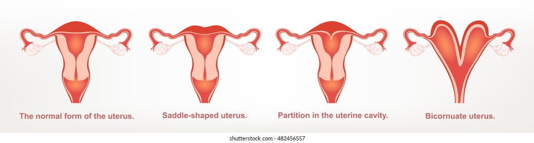 Septum Uterus Images, Stock Photos & Vectors 