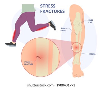 Shin Splint Leg Pain Knee Injury Sport Lower Tibia Strain Tendon Muscle Fall Impact Trauma Bone Joint Runner Painful Crack Small Tiny Fibula Soccer Limb Acute Crush Deep Vein Blood Clot Kneecap Ache