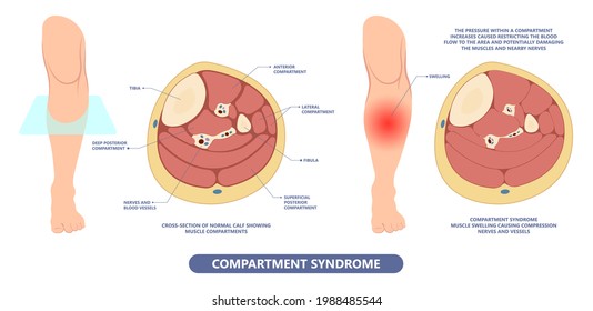 Shin Splint Leg Pain Knee Injury Sport Lower Tibia Strain Tendon Muscle Fall Impact Trauma Bone Joint Runner Painful Crack Small Tiny Fibula Soccer Limb Acute Crush Deep Vein Blood Clot Kneecap Ache