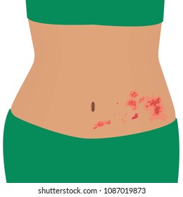 Shingles on a woman body vector illustration