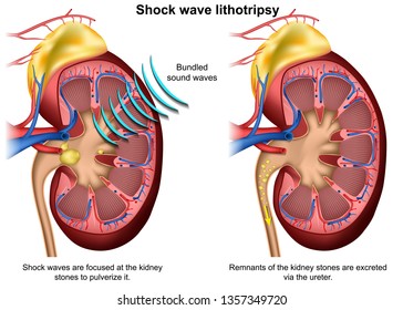 Shock wave lithotripsy 3d medical vector illustration on white background