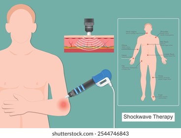 Die Schockwellentherapie bei Tenniselbow (laterale Epicondylitis) wurde zur Behandlung von LE zur Linderung von Schmerzen und Funktionsstörungen, die durch den Tenniselbow verursacht wurden, eingesetzt. medizinische Versorgung, Vektorgrafik.