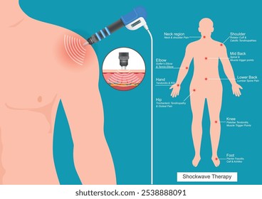 Tratamento de onda de choque para a tendinite do ombro com máquina de onda de choque extracorpórea. Promove o alívio da dor, a recuperação muscular e a saúde espinhal. (ESWT para abreviar) Assistência médica, ilustração vetorial.