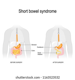 short gut. Before surgery and after surgery. Short bowel syndrome is a disorder caused by a lack of part of small intestine. Vector illustration for biology, scientific, and medical use.