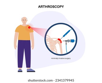 Shoulder arthroscopy procedure for elderly man. Rotator cuff tears or shoulder joint replacement. Minimally invasive surgery. Tendonitis pain or arthritis inflammation medical vector illustration