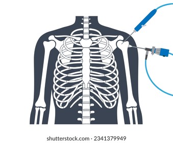 Shoulder arthroscopy procedure. Rotator cuff tears or shoulder impingement. Minimally invasive surgery. Arthroscopic joint treatment, pain and inflammation in human body x ray flat vector illustration